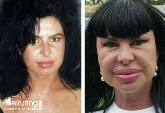 Around the World Social Event Celebrity plastic surgery before and after Lebanon