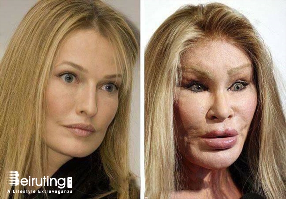 Around the World Social Event Celebrity plastic surgery before and after Lebanon